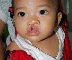 Un bambino indonesiano affetto da labioschisi