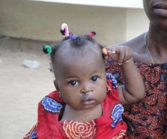 Una dolcissima bambina affetta la labioschisi appena operata in Benin