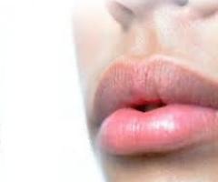 Studio Dentistico - Filler labbra per sposi