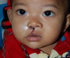 Un bambino indonesiano affetto da labioschisi dopo l’intervento