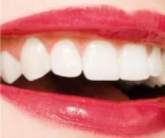 Un sorriso perfetto con Sorriso da Sposa