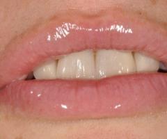 Denti sottoposti al trattamento di estetica dentale